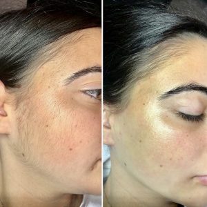 Depilación facial completa